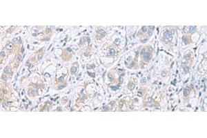Immunohistochemistry of paraffin-embedded Human liver cancer tissue using GPCPD1 Polyclonal Antibody at dilution of 1:55(x200) (GPCPD1 抗体)