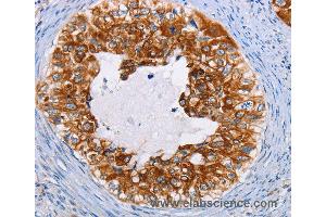 Immunohistochemistry of Human cervical cancer using KRT13 Polyclonal Antibody at dilution of 1:35 (Cytokeratin 13 抗体)
