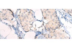Immunohistochemistry of paraffin-embedded Human breast cancer tissue using ANAPC15 Polyclonal Antibody at dilution of 1:50(x200) (ANAPC15 抗体)