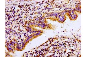 Immunohistochemistry of paraffin-embedded human lung cancer using ABIN7143021 at dilution of 1:100 (ACO2 抗体  (AA 452-676))
