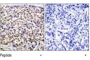 Immunohistochemical analysis of paraffin-embedded human breast carcinoma tissue using CREB1 polyclonal antibody  . (CREB1 抗体  (Ser129))