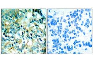 Immunohistochemical analysis of paraffin- embedded human breast carcinoma tissue using Src (phospho- Tyr418) antibody. (Src 抗体  (pTyr418))