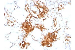 Formalin-fixed, paraffin-embedded human Angiosarcoma stained with Glycophorin A Monoclonal Antibody (SPM599) (CD235a/GYPA 抗体)