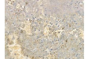 ABIN6265106 and ABIN6277039 at 1/100 staining human melanoma by IHC-P.