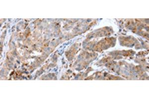 Immunohistochemistry of paraffin-embedded Human breast cancer tissue using CALB2 Polyclonal Antibody at dilution of 1:25(x200) (Calretinin 抗体)