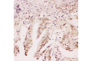 Anti-ATF1 Picoband antibody,  IHC(P): Human Intestinal Cancer Tissue (AFT1 抗体  (AA 1-271))