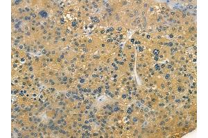 ABIN6257374 and ABIN6273951 at 1/100 staining human hepatocellular carcinoma by IHC-P.