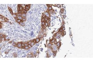 ABIN6272741 at 1/100 staining Human Head and neck cancer tissue by IHC-P. (TAS2R38 抗体  (Internal Region))