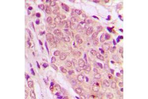 Immunohistochemical analysis of SMAD2/3 staining in human breast cancer formalin fixed paraffin embedded tissue section. (Smad2/3 抗体  (N-Term))