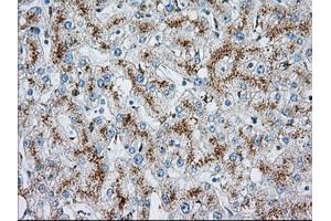 Immunohistochemical staining of paraffin-embedded Carcinoma of liver tissue using anti-MTRF1L mouse monoclonal antibody. (MTRF1L 抗体)