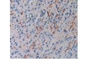 IHC-P analysis of Human Prostate Gland Cancer Tissue, with DAB staining. (FLNC 抗体  (AA 17-259))