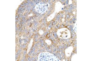 Immunohistochemistry of paraffin-embedded human colon carcinoma using Cation-independent M6PR (IGF2R) antibody (ABIN7267905) at dilution of 1:200 (40x lens). (IGF2R 抗体)
