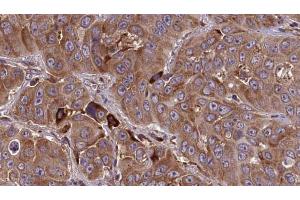 ABIN6273838 at 1/100 staining Human liver cancer tissue by IHC-P. (HTR3E 抗体  (Internal Region))