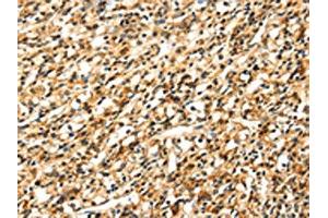 The image on the left is immunohistochemistry of paraffin-embedded Human prostate cancer tissue using ABIN7131054(SIGLEC12 Antibody) at dilution 1/35, on the right is treated with fusion protein. (SIGLEC12 抗体)