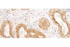 Immunohistochemistry of paraffin-embedded Human breast cancer tissue using ORC4 Polyclonal Antibody at dilution of 1:80(x200) (ORC4 抗体)