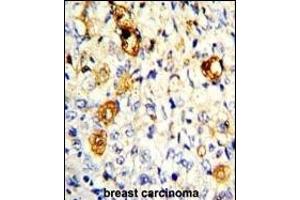 Formalin-fixed and paraffin-embedded human breast carcinoma with P19 Antibody (C-term), which was peroxidase-conjugated to the secondary antibody, followed by DAB staining. (MMP19 抗体  (C-Term))