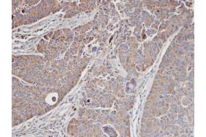 IHC-P Image Immunohistochemical analysis of paraffin-embedded SW480 xenograft, using MRCK alpha, antibody at 1:100 dilution. (CDC42BPA 抗体)