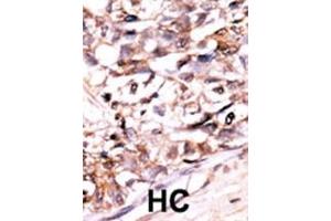 Formalin-fixed and paraffin-embedded human cancer tissue reacted with the primary antibody, which was peroxidase-conjugated to the secondary antibody, followed by AEC staining. (DUSP13-M1 (AA 1-30), (N-Term) 抗体)