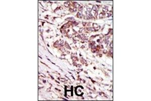 Formalin-fixed and paraffin-embedded human cancer tissue reacted with the primary antibody, which was peroxidase-conjugated to the secondary antibody, followed by AEC staining. (CAMK1G 抗体  (C-Term))
