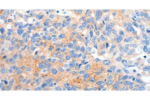 Immunohistochemistry of paraffin-embedded Human ovarian cancer tissue using HCN2 Polyclonal Antibody at dilution 1:80 (HCN2 抗体)