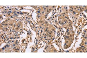 Immunohistochemistry of paraffin-embedded Human lung cancer using IDH1 Polyclonal Antibody at dilution of 1:50 (IDH1 抗体)