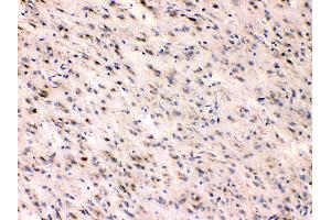 Beta III Tubulin was detected in paraffin-embedded sections of human glioma tissues using rabbit anti- Beta III Tubulin Antigen Affinity purified polyclonal antibody (Catalog # ) at 1 µg/mL. (TUBB3 抗体  (C-Term))