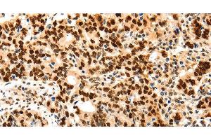 Immunohistochemistry of paraffin-embedded Human gastic cancer using Proliferating Cell Nuclear Antigen Polyclonal Antibody at dilution of 1:44 (PCNA 抗体)