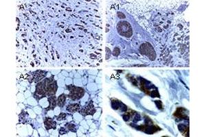 Immunohistochemical analysis of BIRC4 in formalin-fixed, paraffin-embedded human breast carcinoma. (XIAP 抗体)