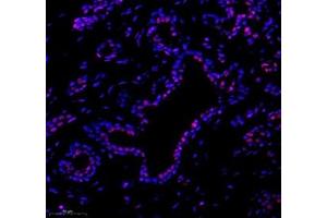Immunofluorescence of paraffin embedded human breast cancer using tfiib (ABIN7074034) at dilution of 1: 500 (300x lens) (GTF2B 抗体)