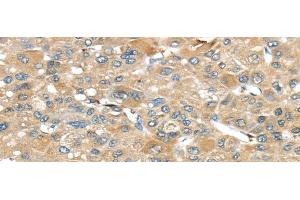 Immunohistochemistry of paraffin-embedded Human liver cancer tissue using SRP54 Polyclonal Antibody at dilution 1:45 (SRP54 抗体)