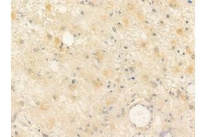 ABIN6254897 and ABIN6266562 at 1/100 staining human astrocytoma by IHC-P. (Neuregulin 1 抗体  (N-Term))