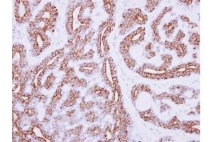 IHC-P Image Immunohistochemical analysis of paraffin-embedded human breast cancer, using IL3 Receptor alpha, antibody at 1:250 dilution. (IL3RA 抗体)