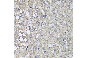 Immunohistochemistry of paraffin-embedded human liver injury using PIK3C2A antibody at dilution of 1:100 (x40 lens). (PIK3C2A 抗体)