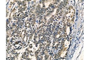ABIN6262948 and ABIN6278588 at 1/100 staining human pancreatic cancer by IHC-P. (GAL4 抗体  (N-Term))
