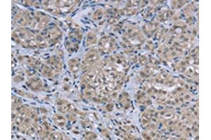 The image on the left is immunohistochemistry of paraffin-embedded Human thyroid cancer tissue using ABIN7129455(FAR2 Antibody) at dilution 1/50, on the right is treated with fusion protein.