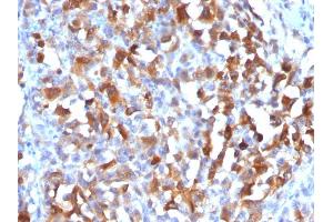 Formalin-fixed, paraffin-embedded human Melanoma stained with MART-1 Rabbit Polyclonal Antibody. (MLANA 抗体)