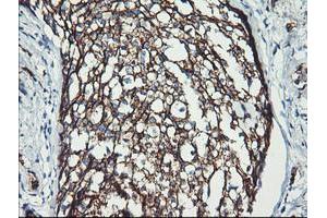 Immunohistochemical staining of paraffin-embedded Adenocarcinoma of Human breast tissue using anti-ERBB2 mouse monoclonal antibody. (ErbB2/Her2 抗体  (AA 676-1255))