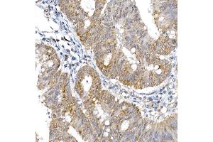 Immunohistochemistry of paraffin-embedded human colon carcinoma using SRP72 Rabbit pAb (ABIN6134166, ABIN6148452, ABIN7101299 and ABIN7101300) at dilution of 1:100 (40x lens). (SRP72 抗体)