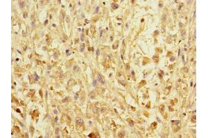 Immunohistochemistry of paraffin-embedded human melanoma using ABIN7151990 at dilution of 1:100 (ERBB2IP 抗体  (AA 1193-1412))