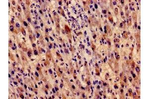 Immunocytochemistry analysis of human liver cancer using ABIN7151520 at dilution of 1:100 (EVC 抗体  (AA 493-602))