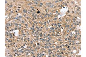 The image on the left is immunohistochemistry of paraffin-embedded Human breast cancer tissue using ABIN7130823(RASGEF1A Antibody) at dilution 1/20, on the right is treated with fusion protein. (RASGEF1A 抗体)