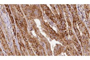 ABIN6267124 at 1/100 staining Human thyroid cancer tissue by IHC-P. (LIPE 抗体  (pSer563))