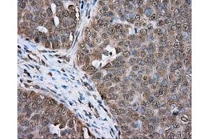 Immunohistochemical staining of paraffin-embedded colon tissue using anti-ERCC1 mouse monoclonal antibody. (ERCC1 抗体)