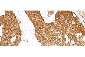 Immunohistochemistry of paraffin-embedded Human colorectal cancer tissue using ZBTB8A Polyclonal Antibody at dilution of 1:100(x200) (ZBTB8A 抗体)