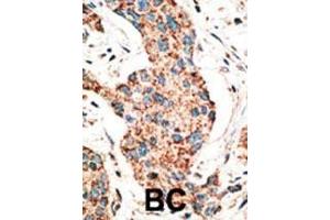 Formalin-fixed and paraffin-embedded human cancer tissue reacted with the primary antibody, which was peroxidase-conjugated to the secondary antibody, followed by AEC staining. (RAD9A 抗体  (AA 1-30))