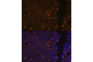 Immunofluorescence analysis of human cervix cancer using Cytokeratin 13 (KRT13) (KRT13) Rabbit mAb (ABIN7268089) at dilution of 1:100 (40x lens). (Cytokeratin 13 抗体)