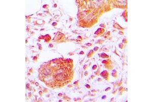 Immunohistochemical analysis of PLC gamma 1 (pY783) staining in human lung cancer formalin fixed paraffin embedded tissue section. (Phospholipase C gamma 1 抗体  (pTyr783))