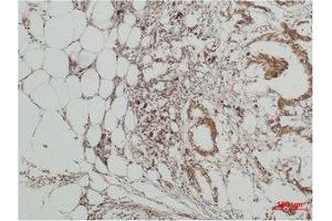 Immunohistochemistry (IHC) analysis of paraffin-embedded Human Breast Carcicnoma using ERK 5 Polyclonal Antibody. (MAPK7 抗体)