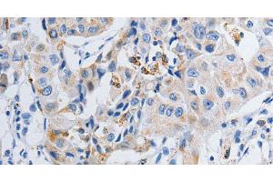 Immunohistochemistry of paraffin-embedded Human lung cancer tissue using GRIA3 Polyclonal Antibody at dilution 1:50 (Glutamate Receptor 3 抗体)