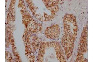 IHC image of ABIN7166043 diluted at 1:100 and staining in paraffin-embedded human prostate cancer performed on a Leica BondTM system. (S1A12 (AA 2-91) 抗体)